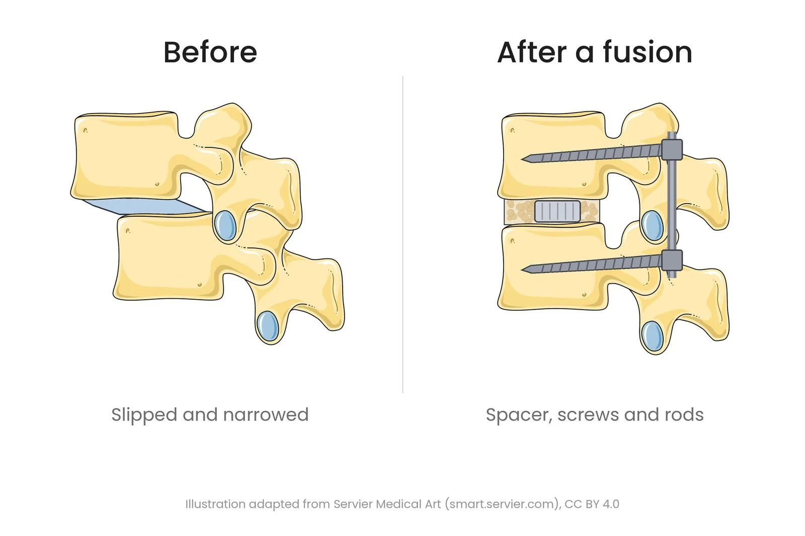 Side view of two lumbar vertebrae before and after a fusion. Before, the upper vertebra has slipped forward and the disc space is narrowed. After, the vertebrae are realigned with a spacer and bone graft in the disc space and screws joined by a rod.