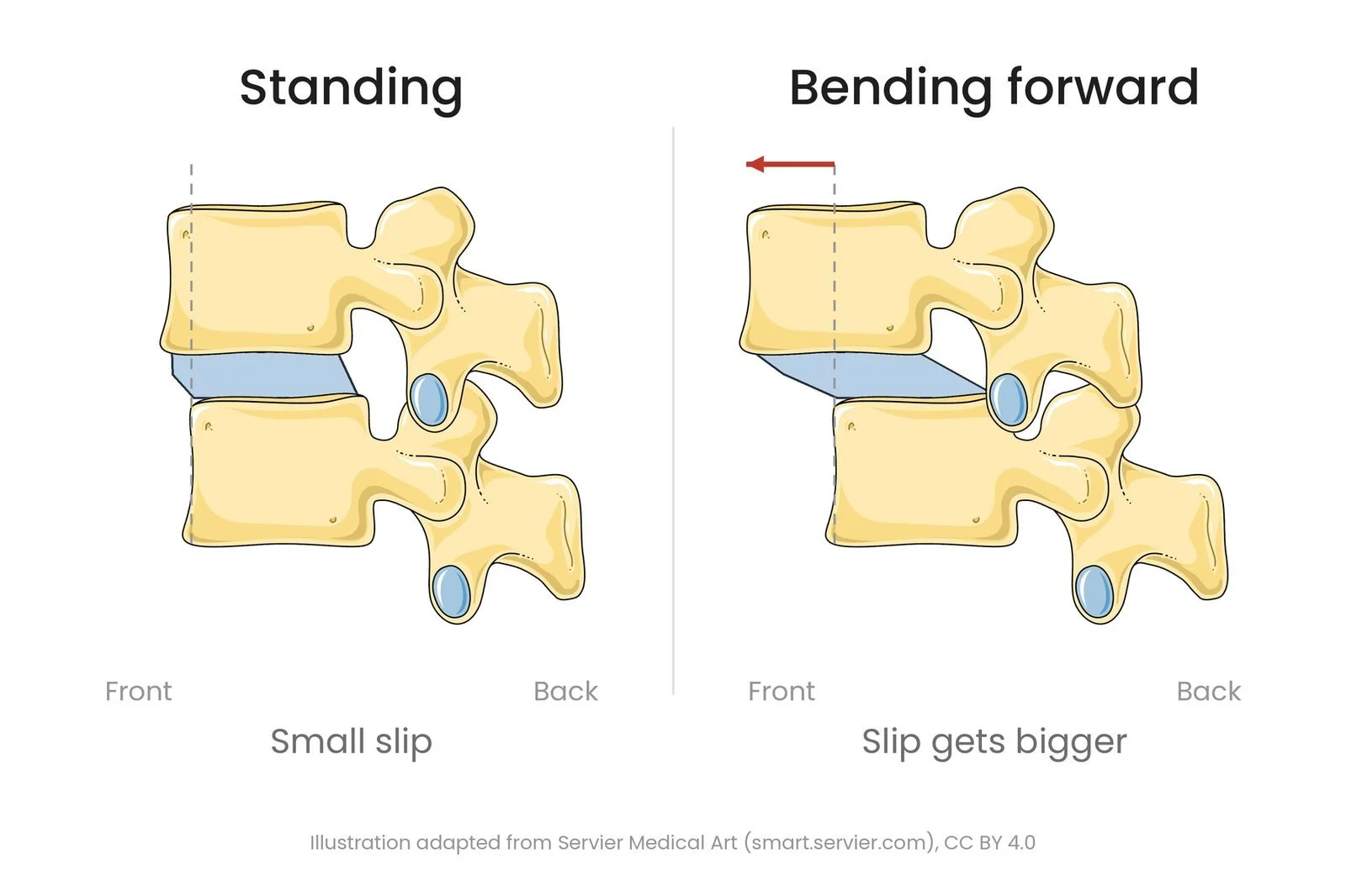Side view of two lumbar vertebrae. Standing, the upper vertebra sits slightly forward of the one below. Bending forward, it slides farther forward, showing an unstable slip.