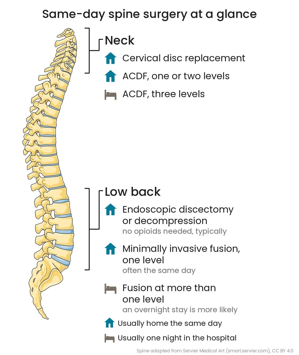 A side view of the spine with the neck and low back marked. Neck: cervical disc replacement and ACDF at one or two levels usually go home the same day; ACDF at three levels usually stays one night. Low back: endoscopic discectomy or decompression usually goes home the same day; minimally invasive fusion at one level often does; fusion at more than one level more likely stays overnight.