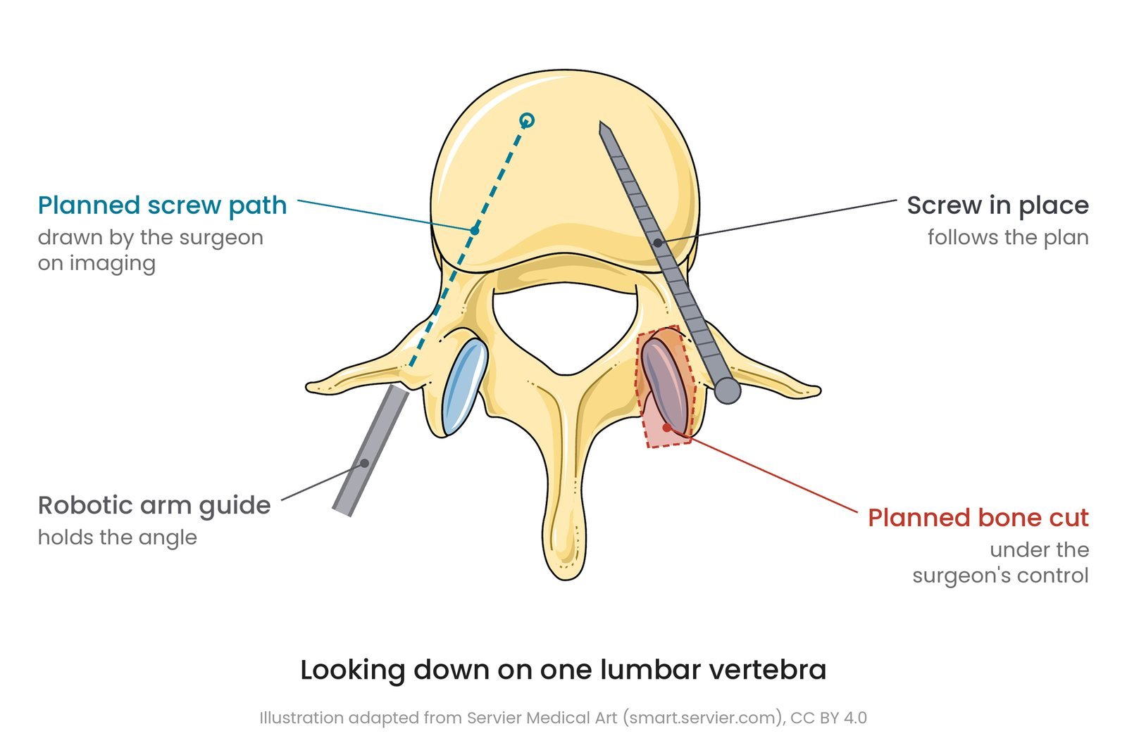 A lumbar vertebra seen from above, showing a planned screw path drawn on imaging, the robotic arm guide lined up with it, a screw placed along the plan on the other side, and a planned bone cut.
