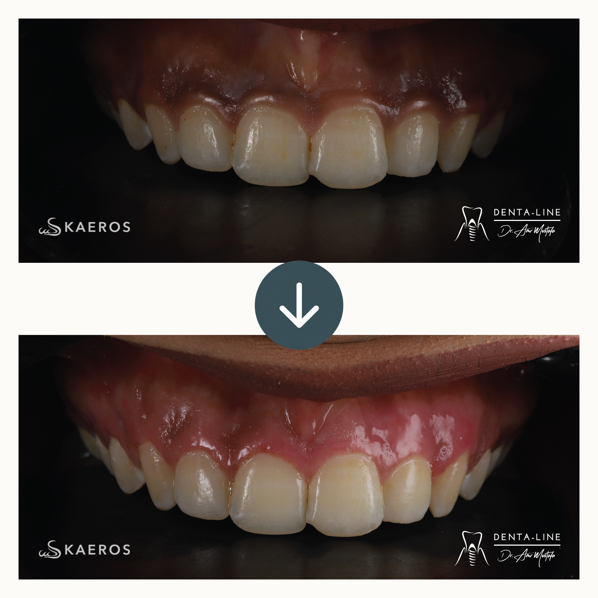 Gum Treatment before and after result