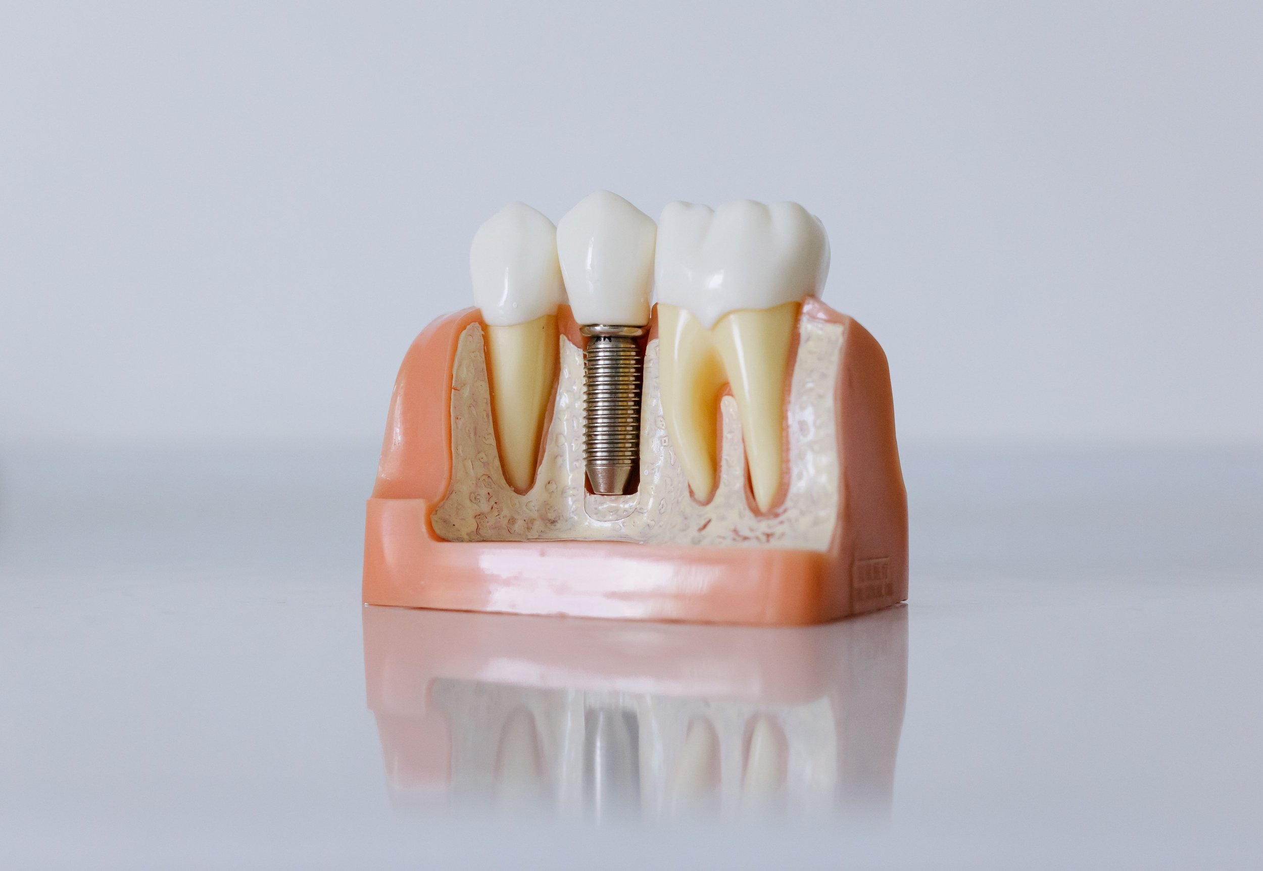 Dental implant replacing a missing tooth