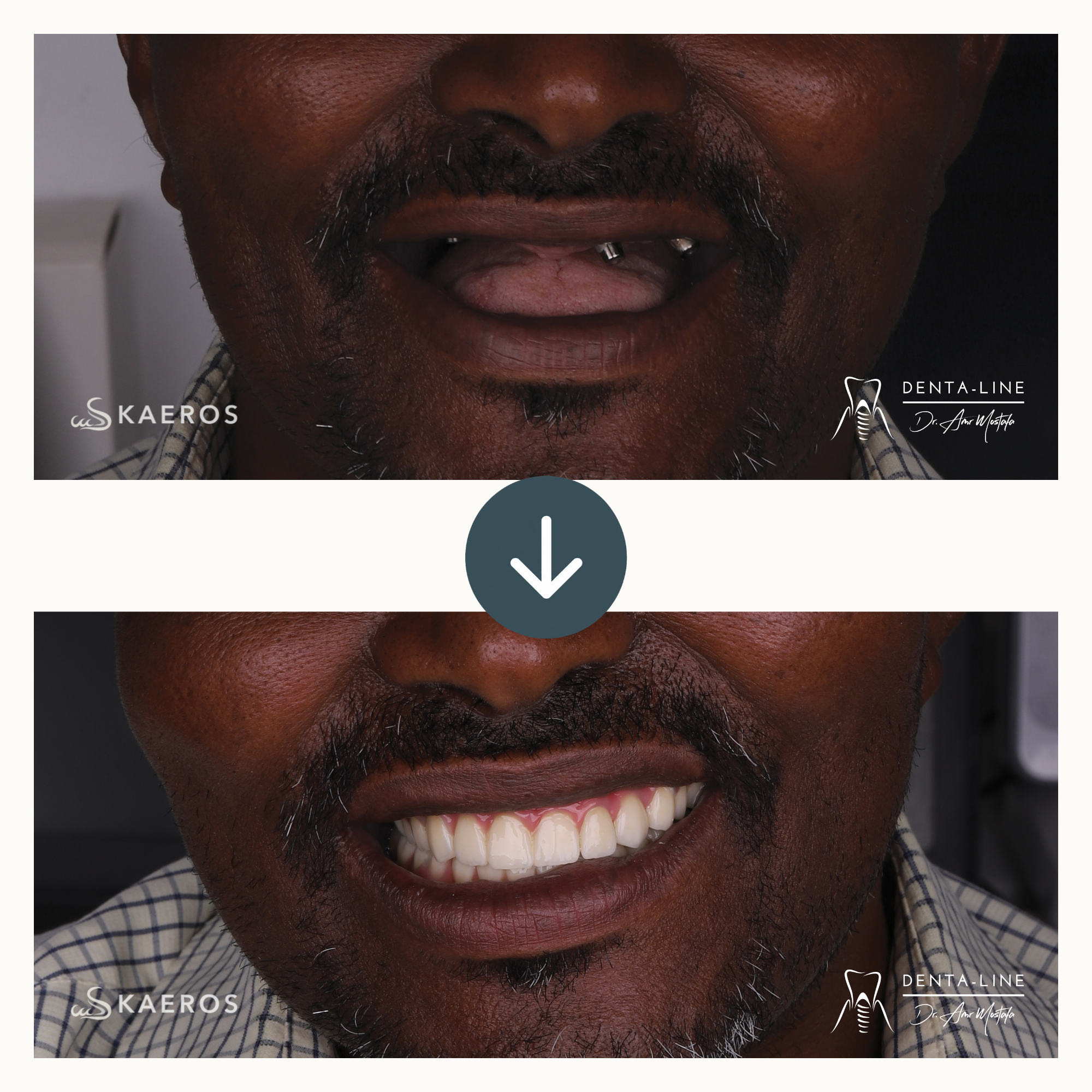 Implant-supported Smile Rehabilitation before and after result