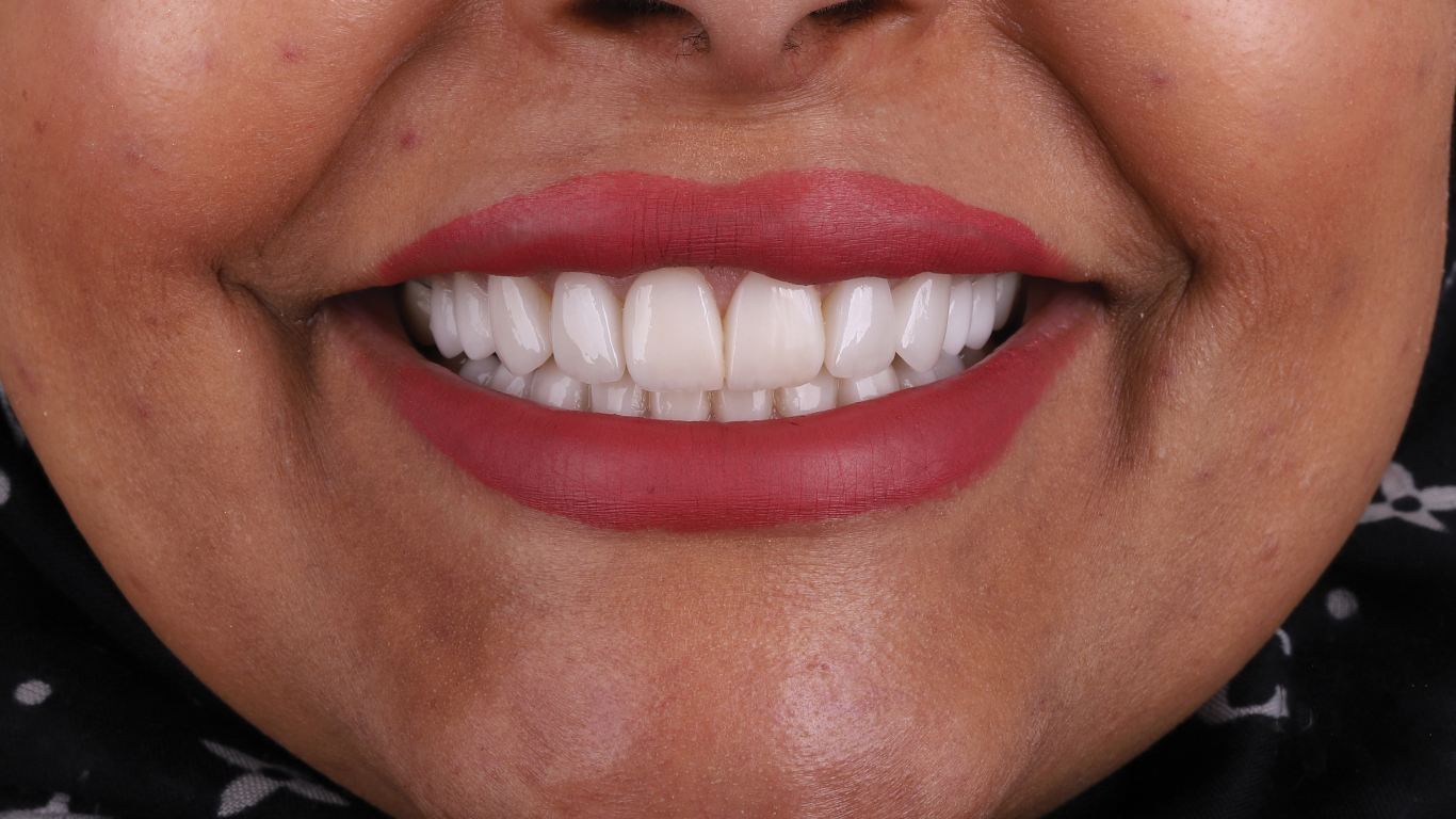Full Smile Veneers before and after result