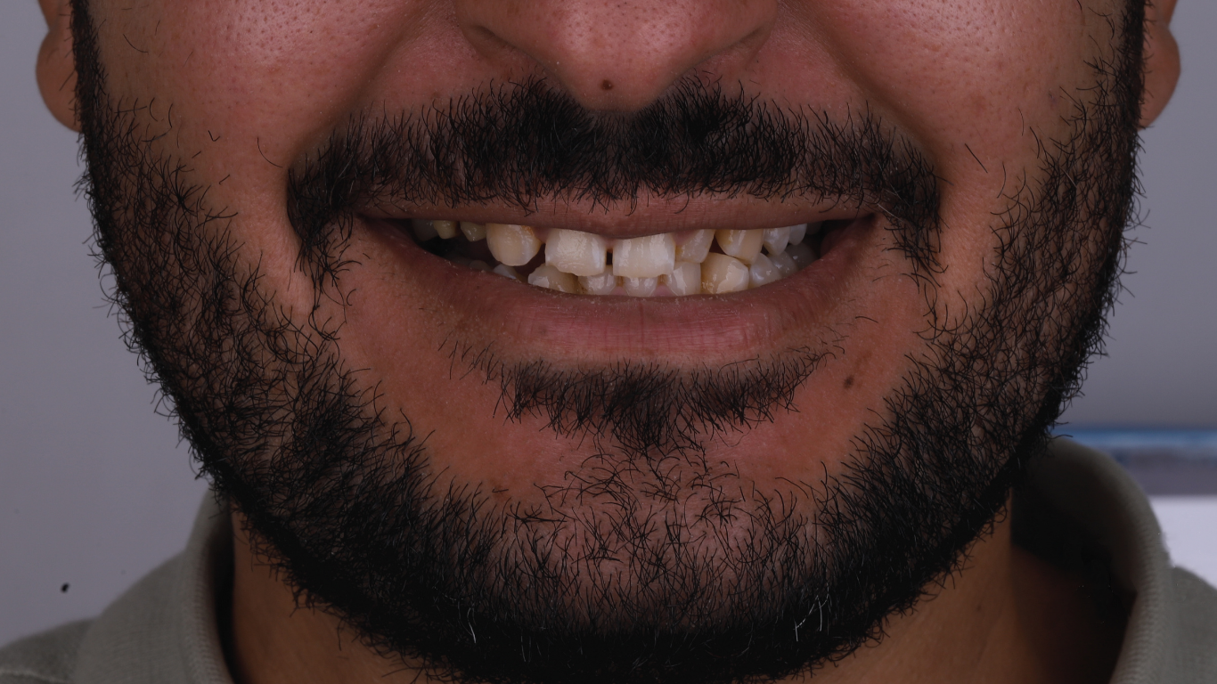 Before full smile veneers