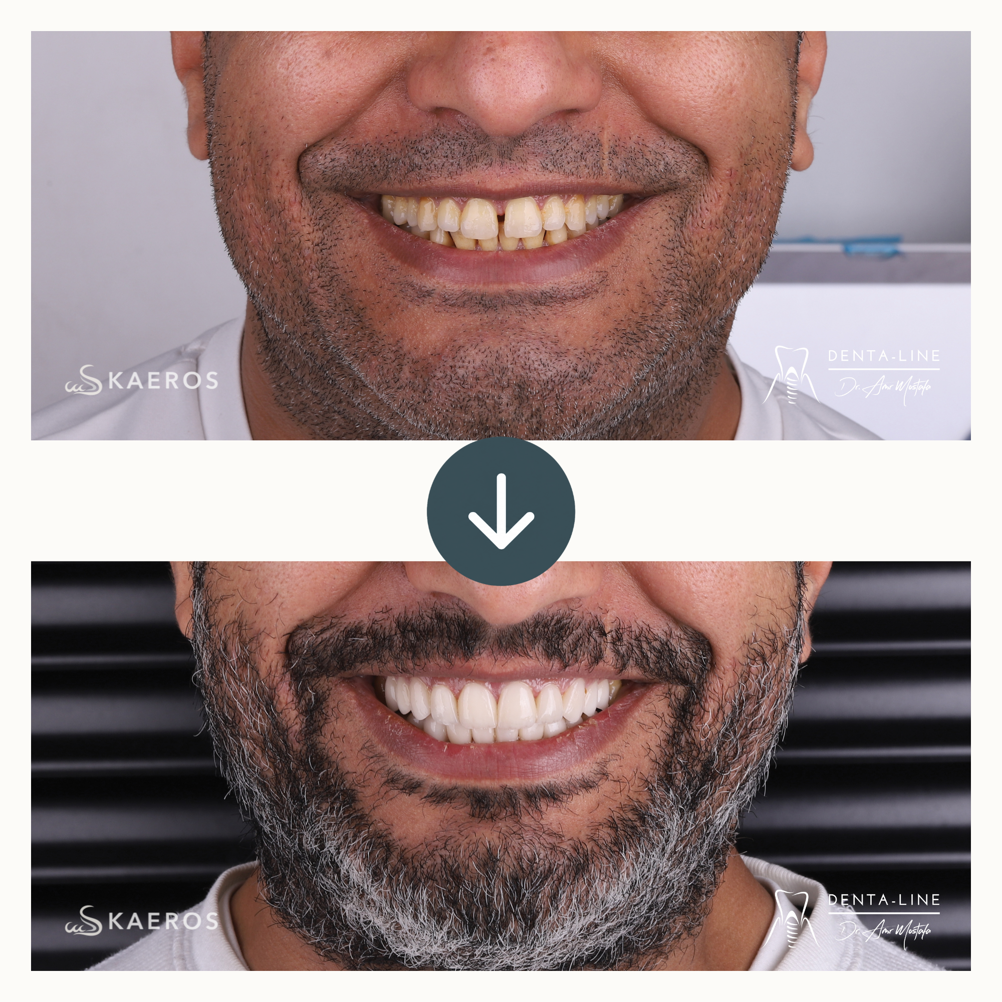 Full Smile Veneers before and after result