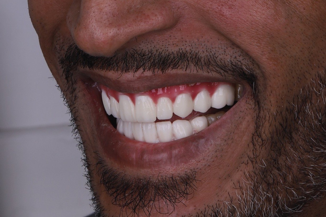 After smile rehabilitation