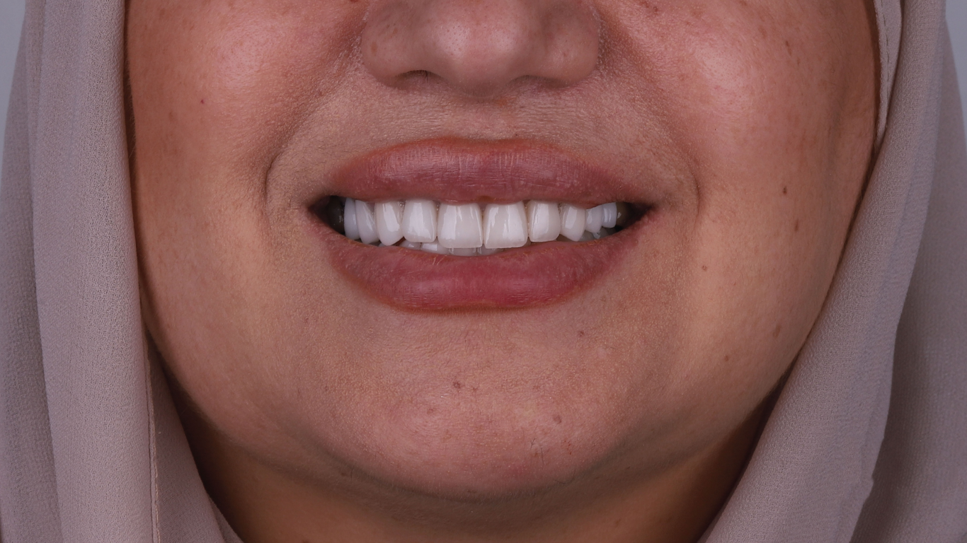Full Smile Veneers