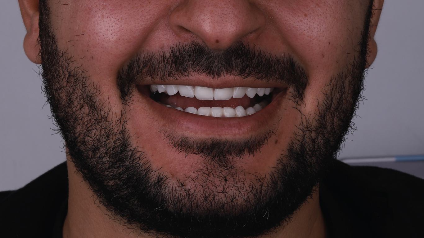 After full smile veneers