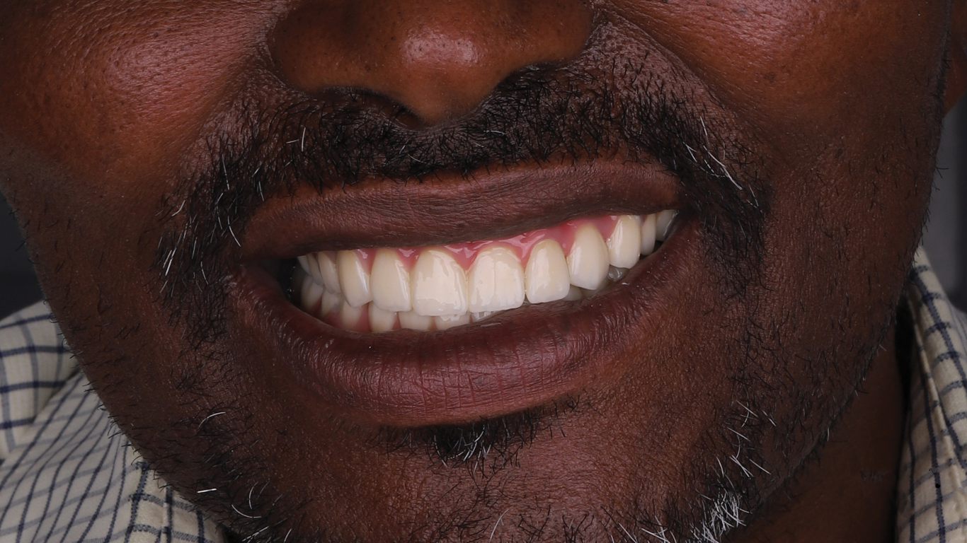Other dental care before and after result