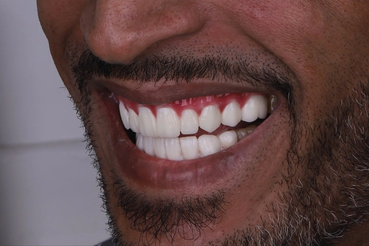 Smile Rehabilitation
