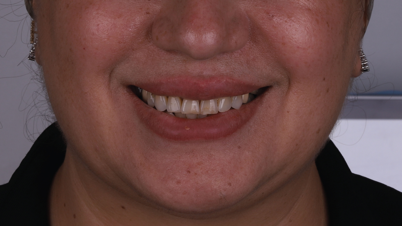 Before full smile veneers