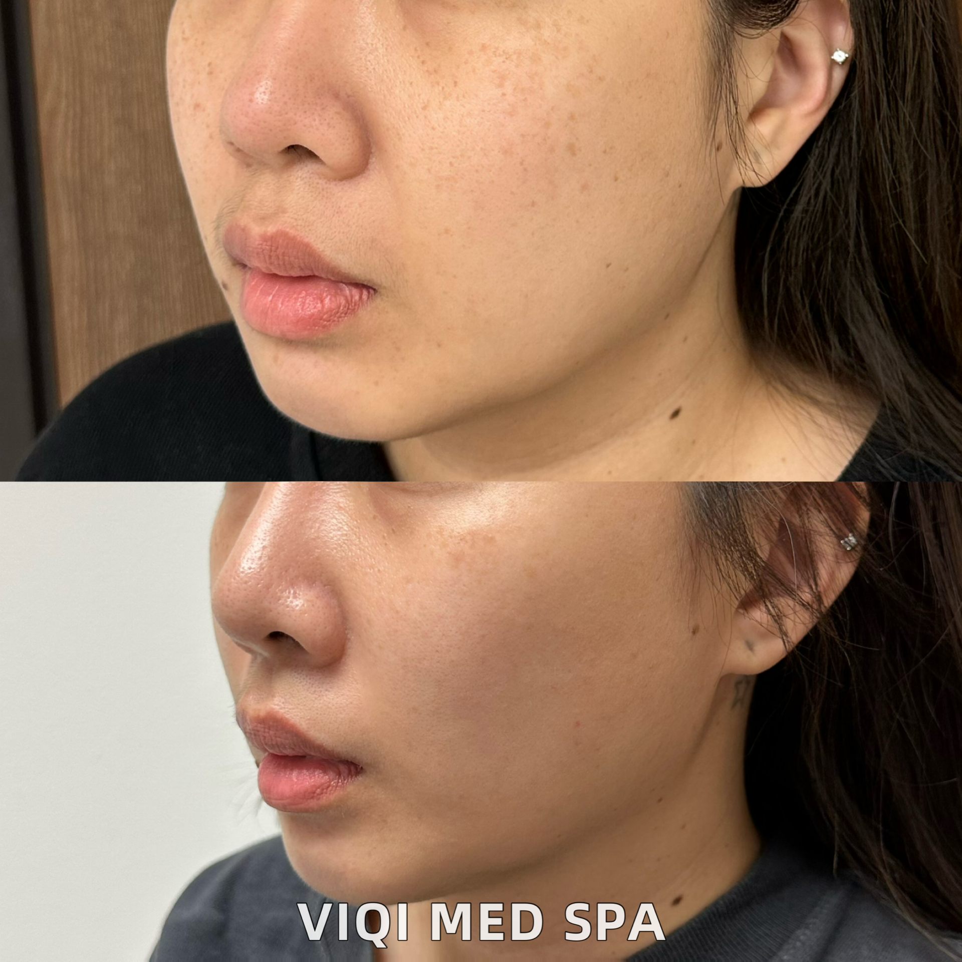 VIQI IPL pigmentation photo comparison 2, before above and after below