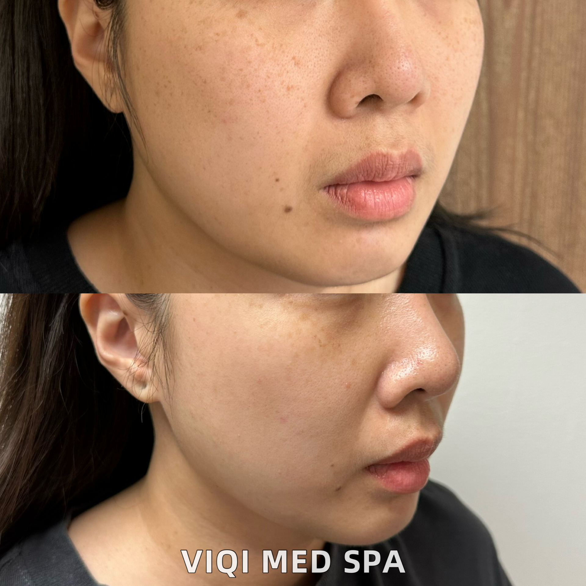 VIQI IPL pigmentation photo comparison 1, before above and after below