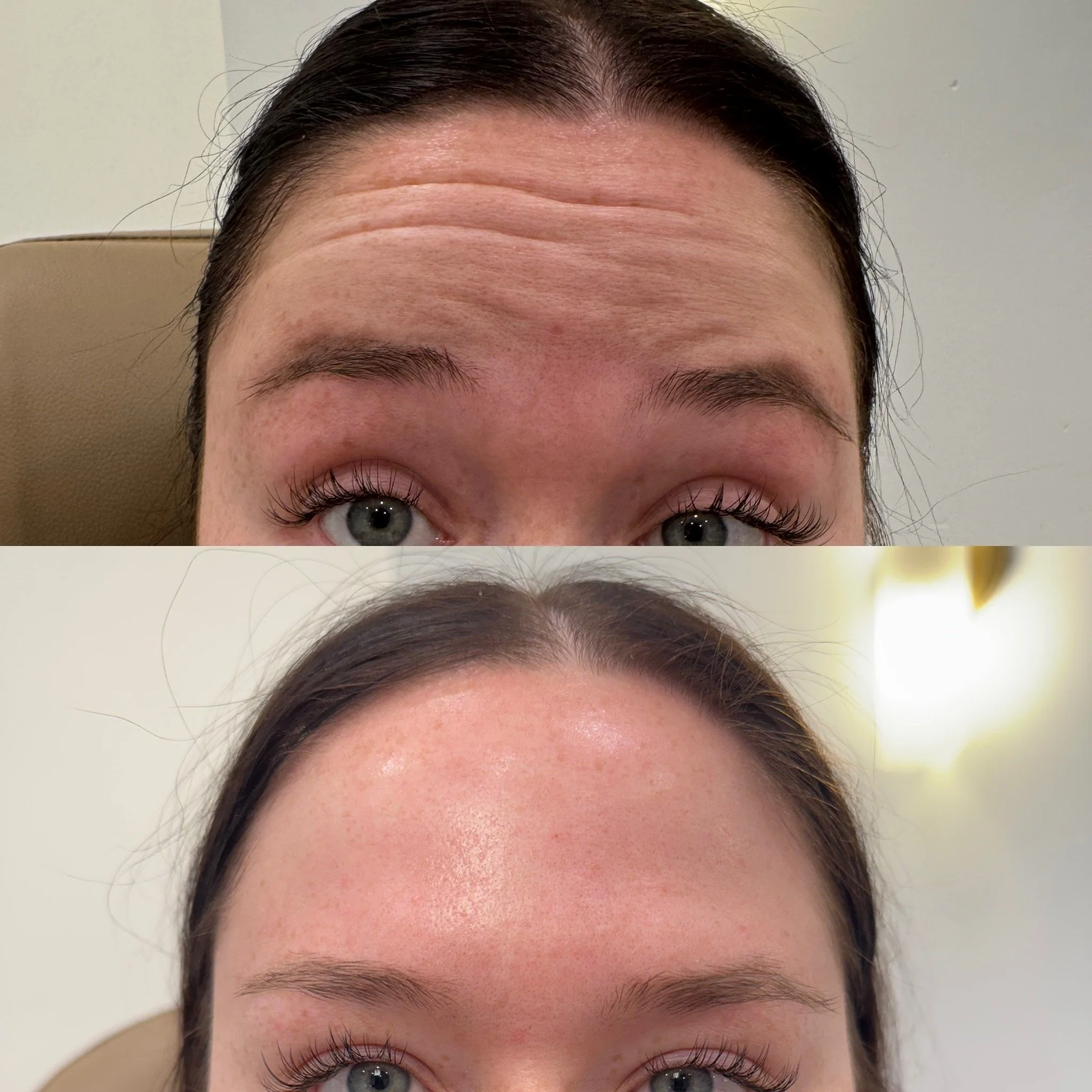 Before and after wrinkle relaxer results
