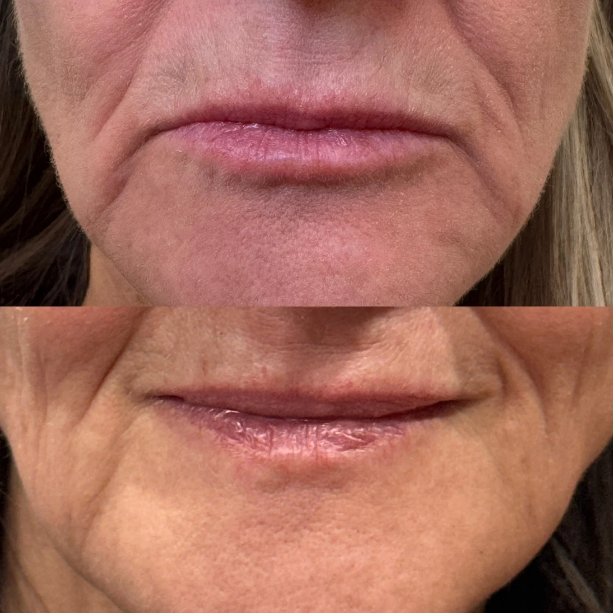 Before and after wrinkle relaxer results
