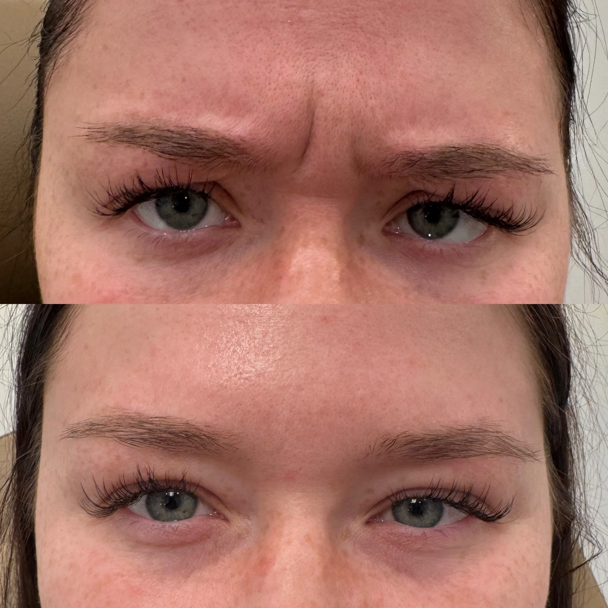Before and after wrinkle relaxer results
