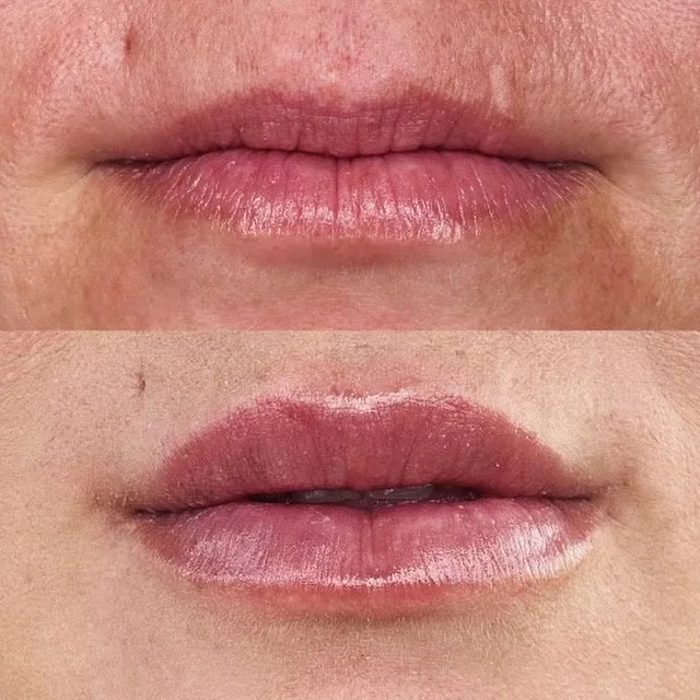 Lip Filler at Hidden Springs Med Spa