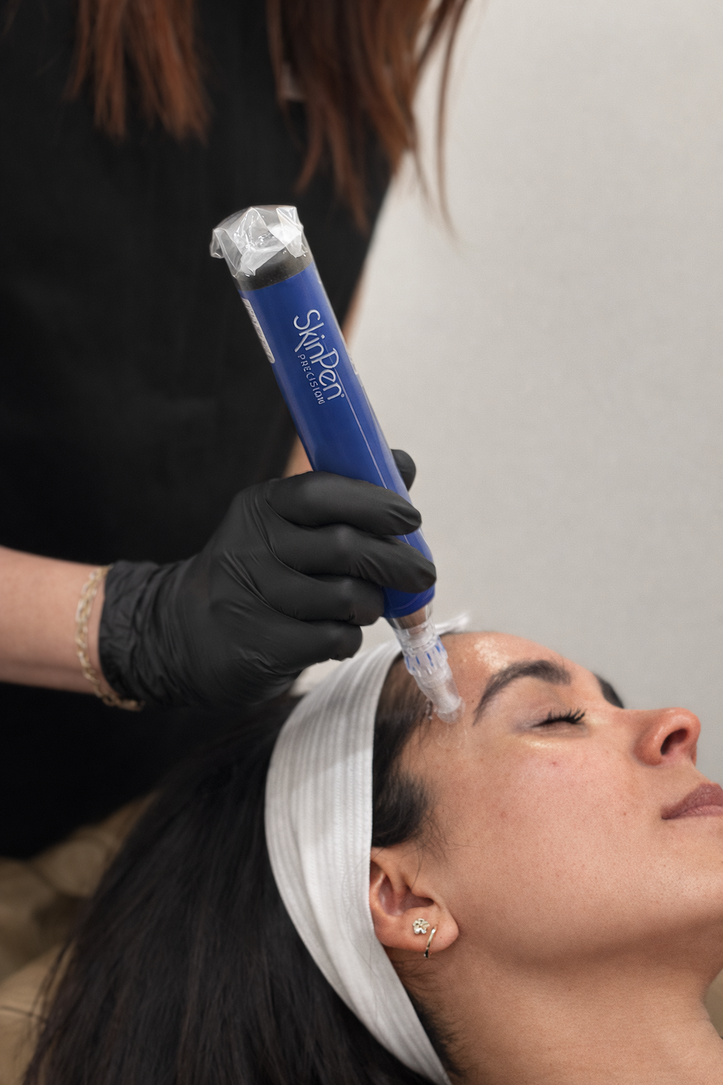 Microneedling