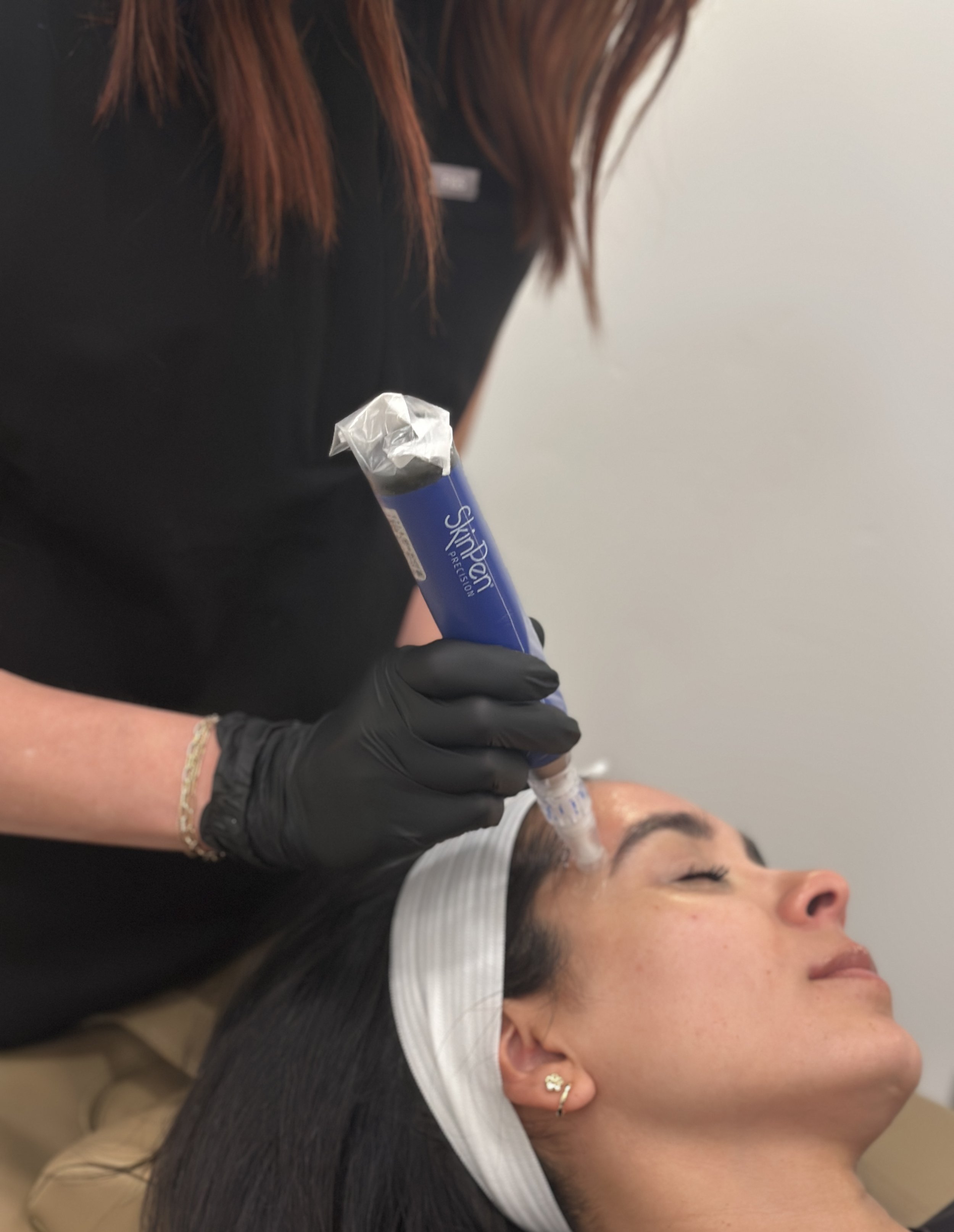 Microneedling Treatment
