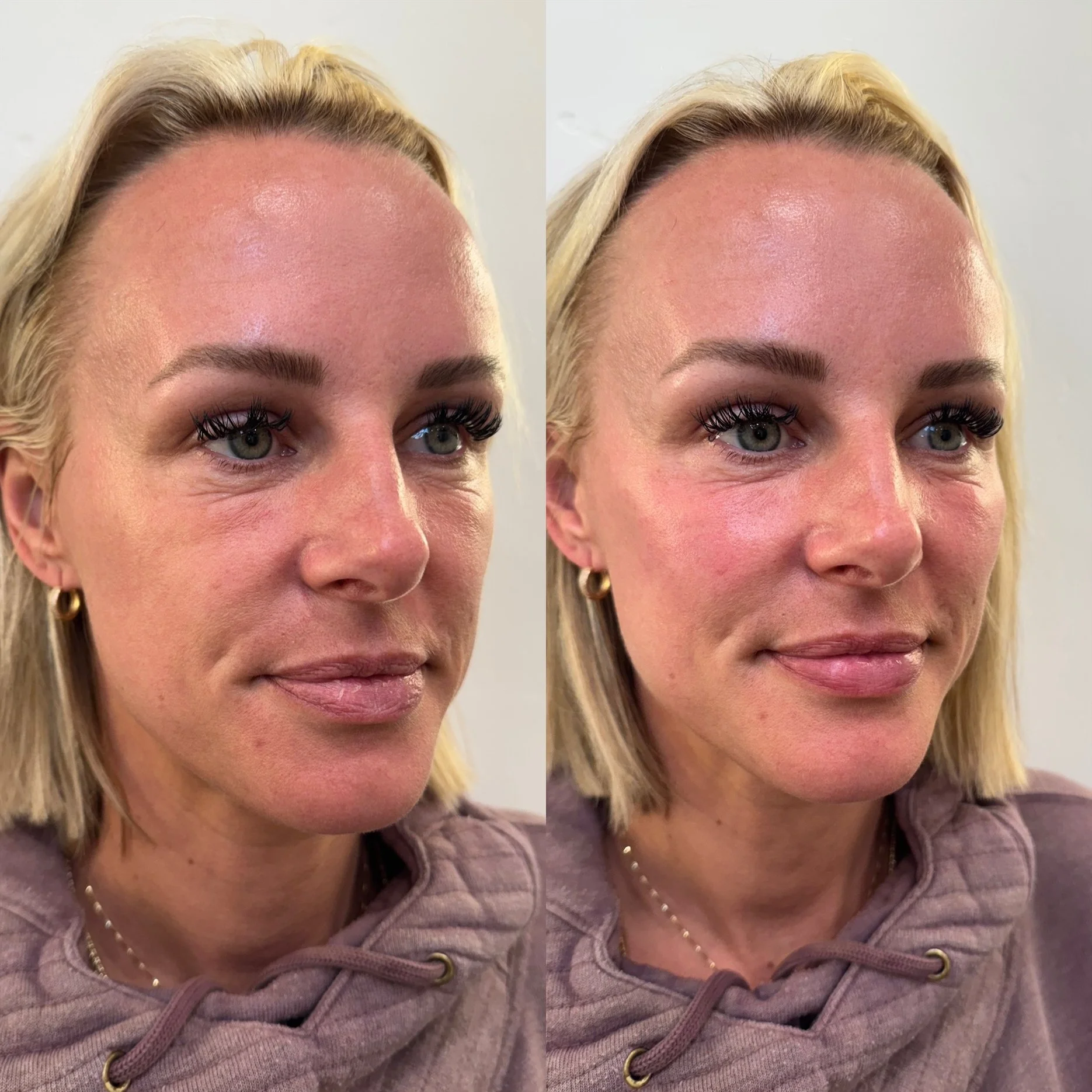 Dermal Fillers at Hidden Springs Wellness and Med Spa