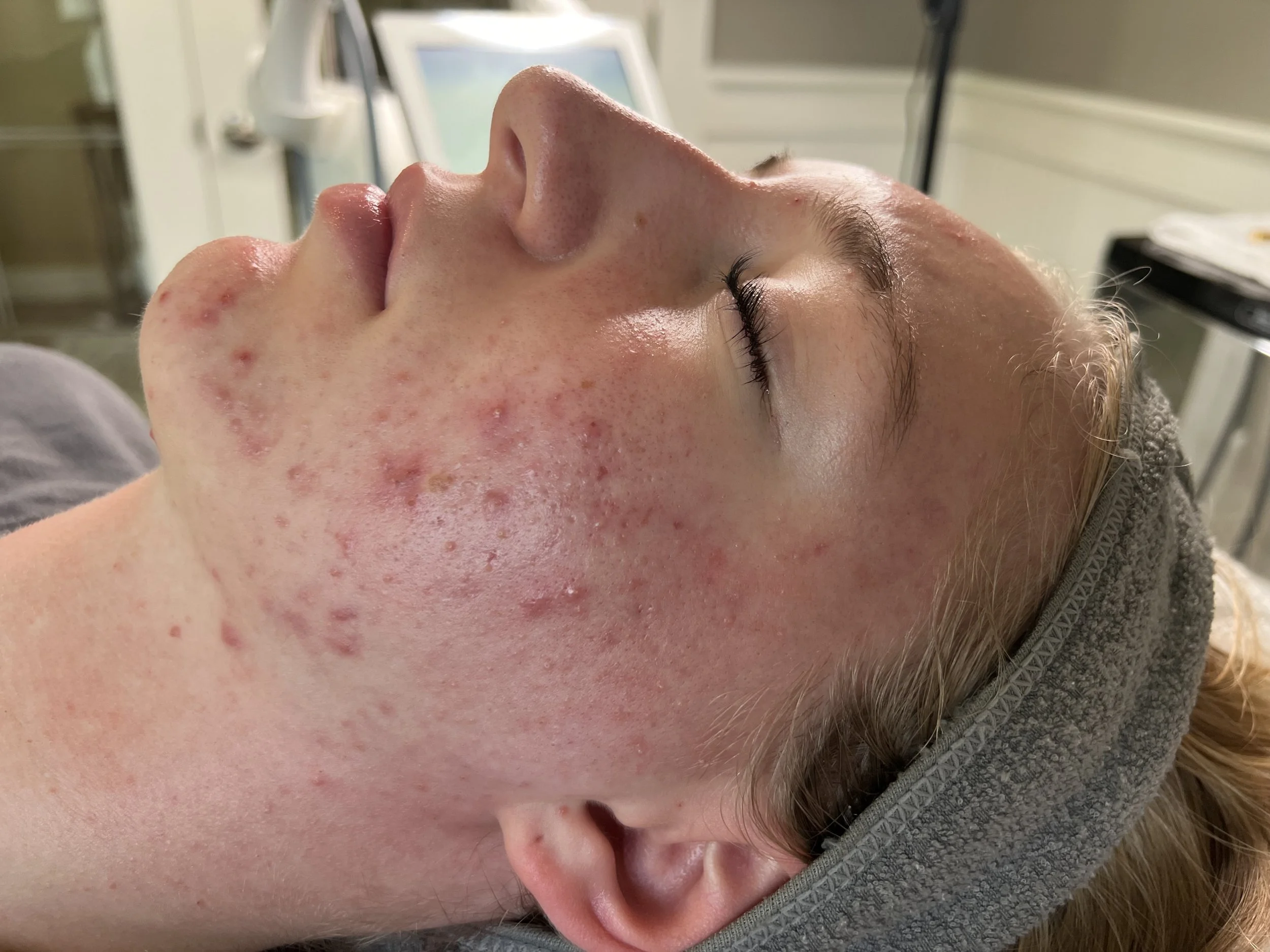 Before photo showing skin prior to acne treatment at Hidden Springs Med Spa in Boise, ID