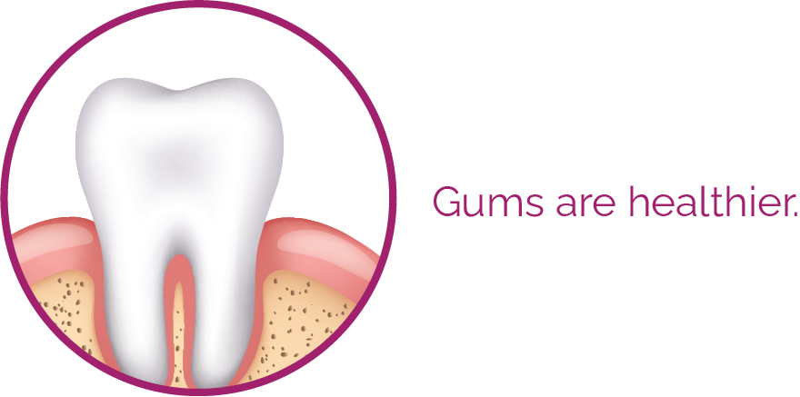 Healthier gums after Laser Pocket Disinfection