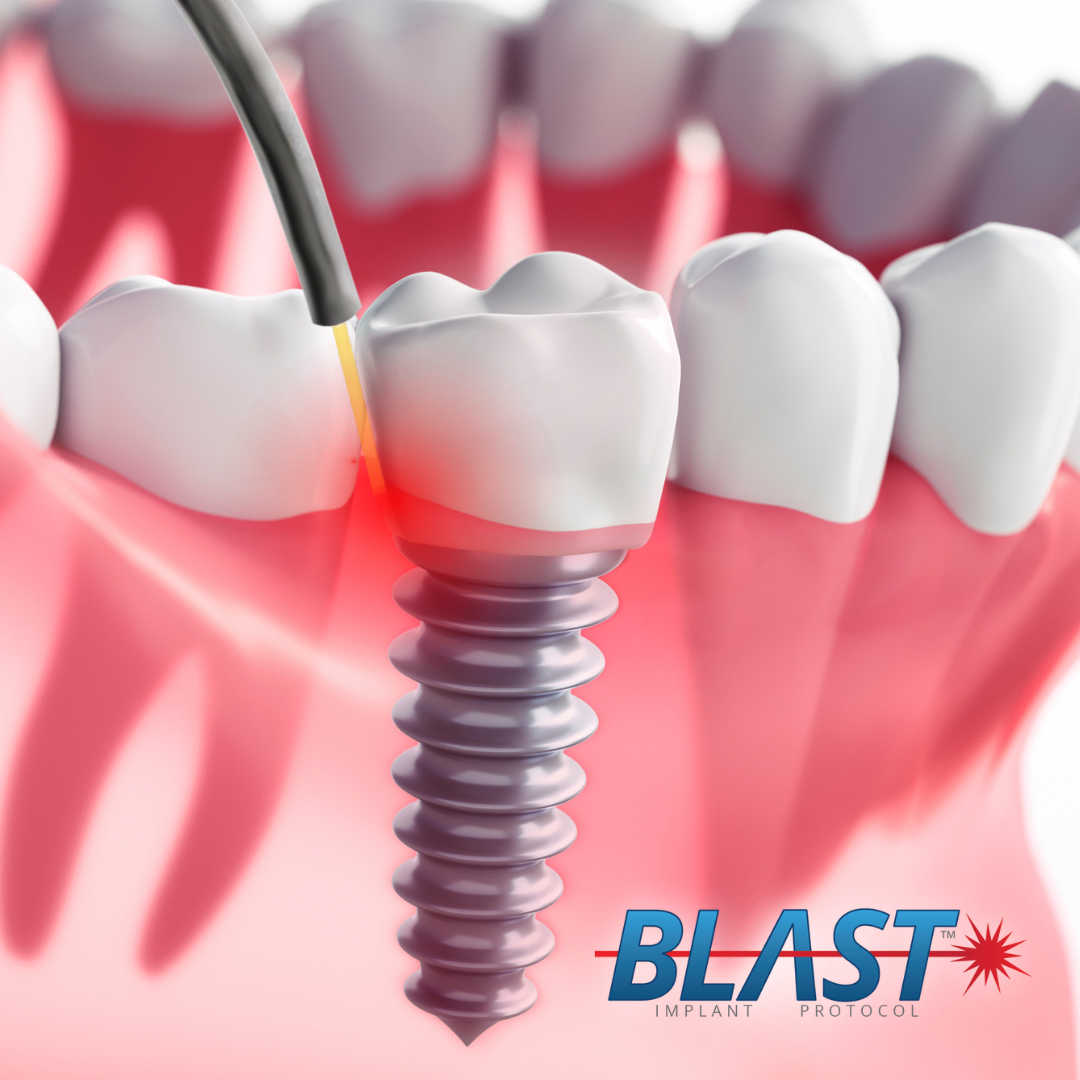 BLAST laser-assisted implant support