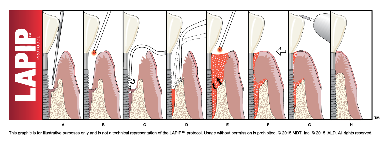LAPIP protocol laser implant rescue process