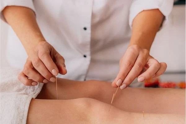 Acupuncture needle placement for knee pain at Los Angeles clinic