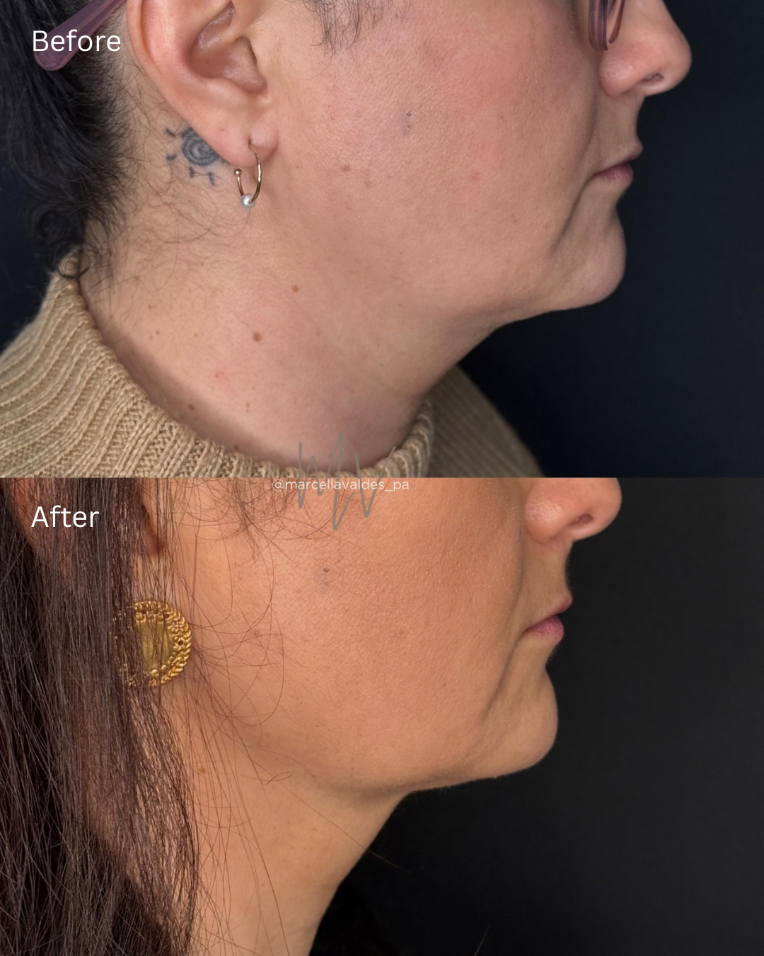 Submental Liquid Lipo before and after — EMVEE Medspa Coral Gables
