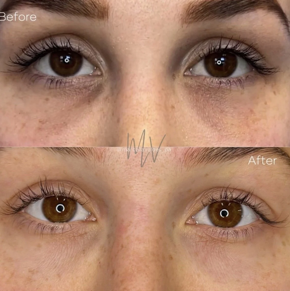 Undereye PRF before and after — EMVEE Medspa Coral Gables