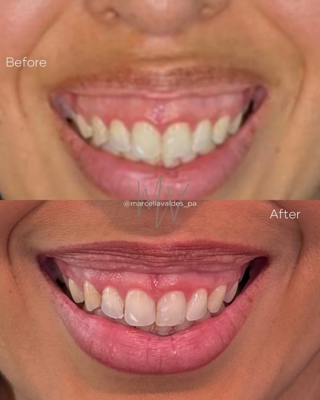 Gummy smile Botox before and after — EMVEE Medspa Coral Gables