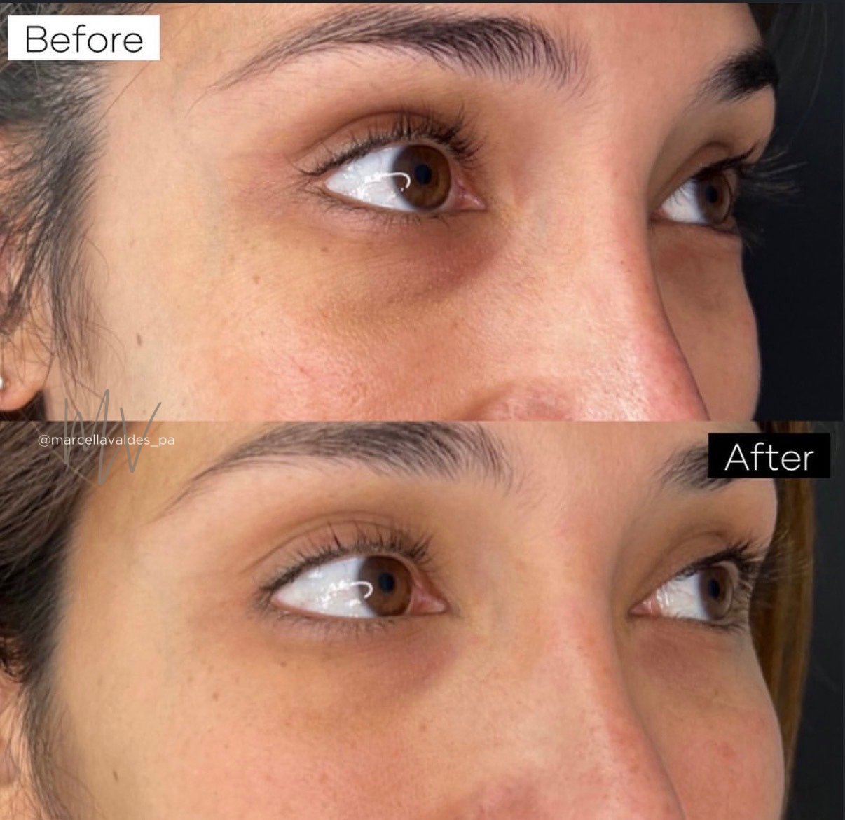 Undereye PRF before and after — EMVEE Medspa Coral Gables