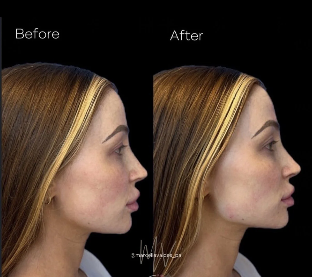 Jawline filler before and after — EMVEE Medspa Coral Gables