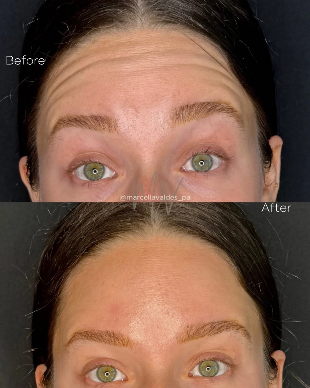 Forehead Botox before and after — EMVEE Medspa Coral Gables