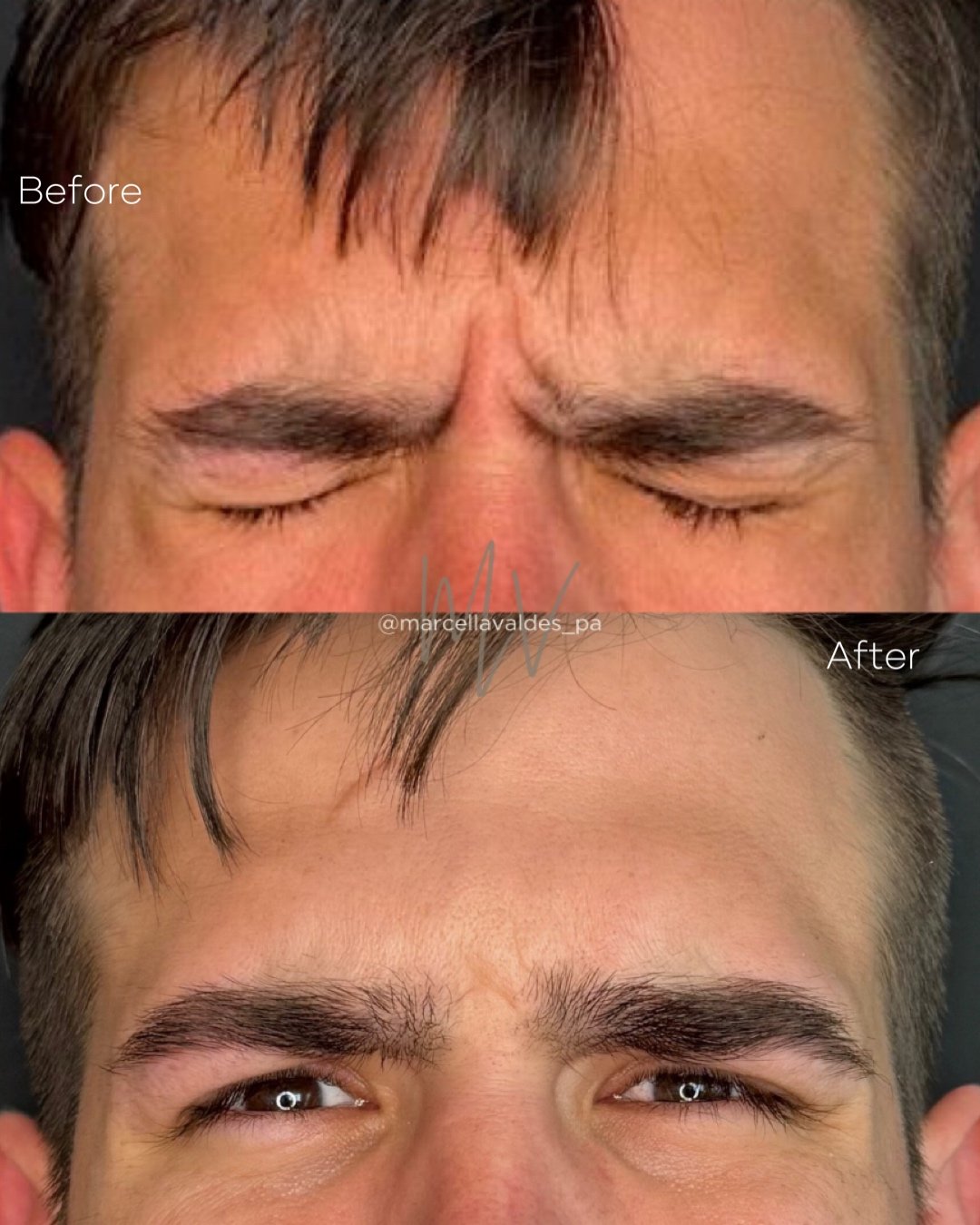Glabella Botox before and after — EMVEE Medspa Coral Gables
