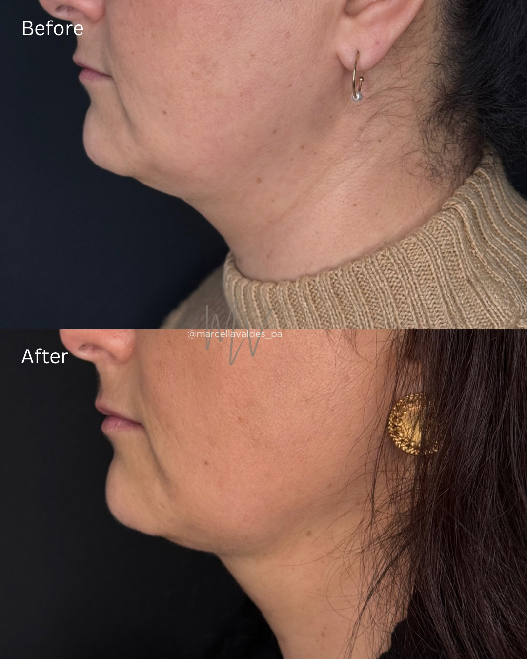 Submental Liquid Lipo before and after — EMVEE Medspa Coral Gables