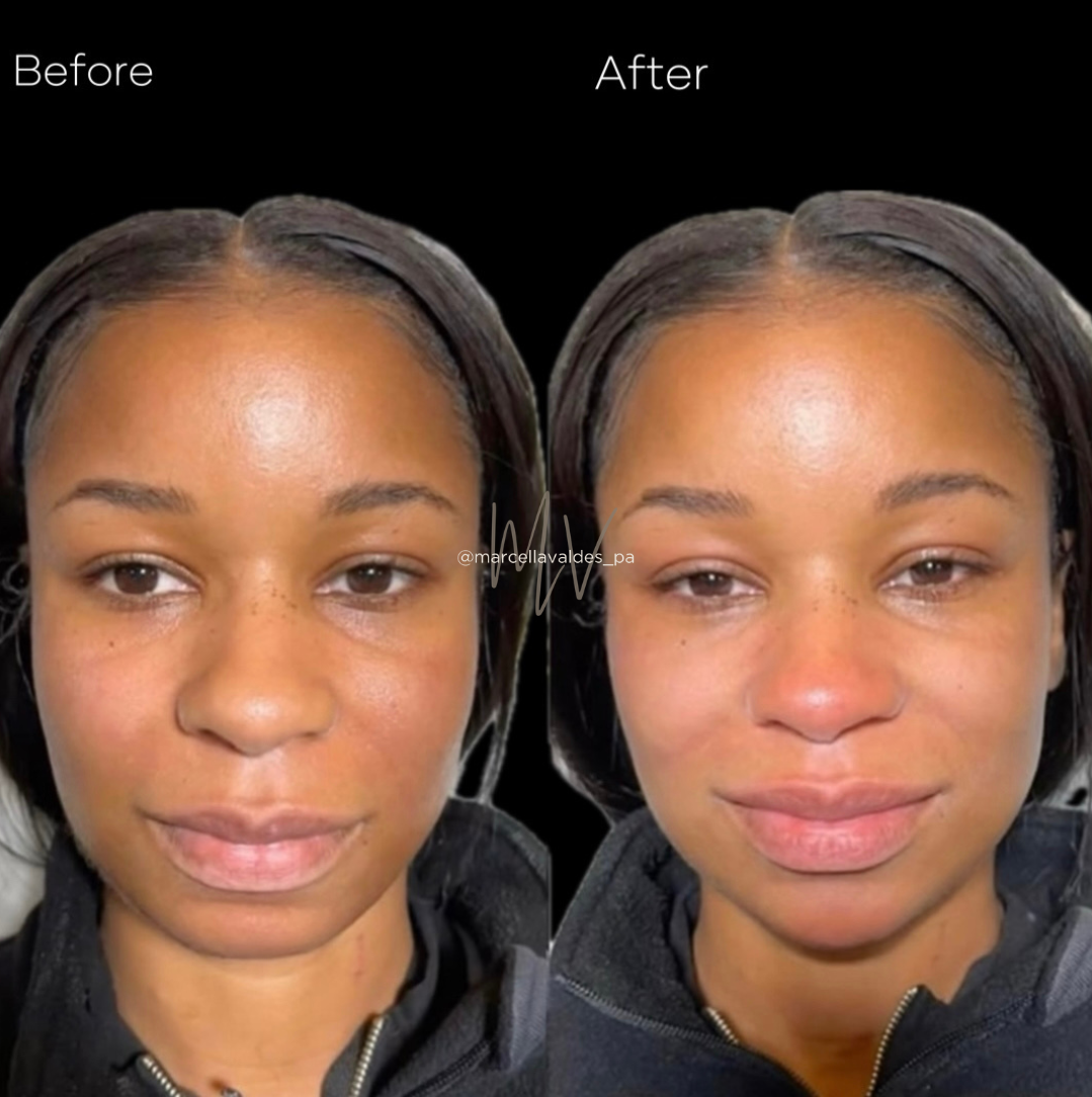 Chin filler before and after — EMVEE Medspa Coral Gables