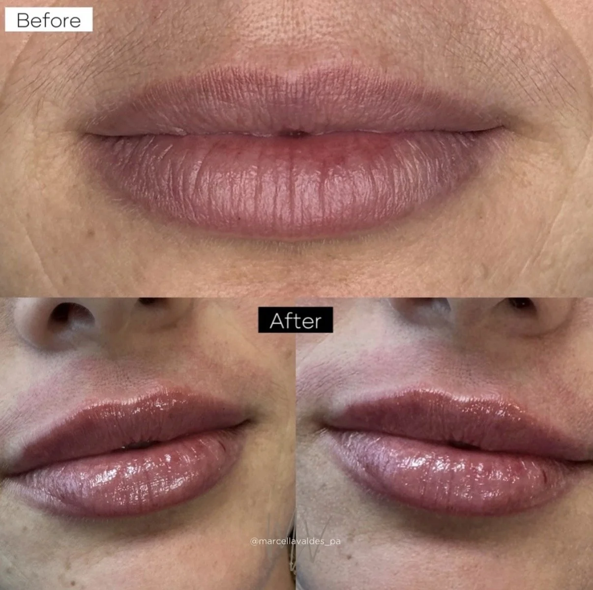 Lip filler before and after — EMVEE Medspa Coral Gables