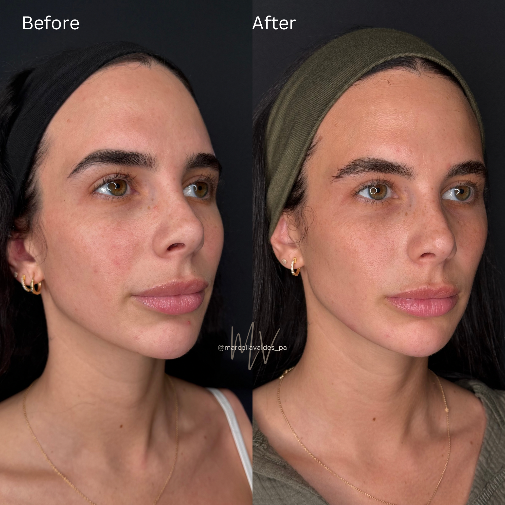 Sculptra to face before and after — EMVEE Medspa Coral Gables