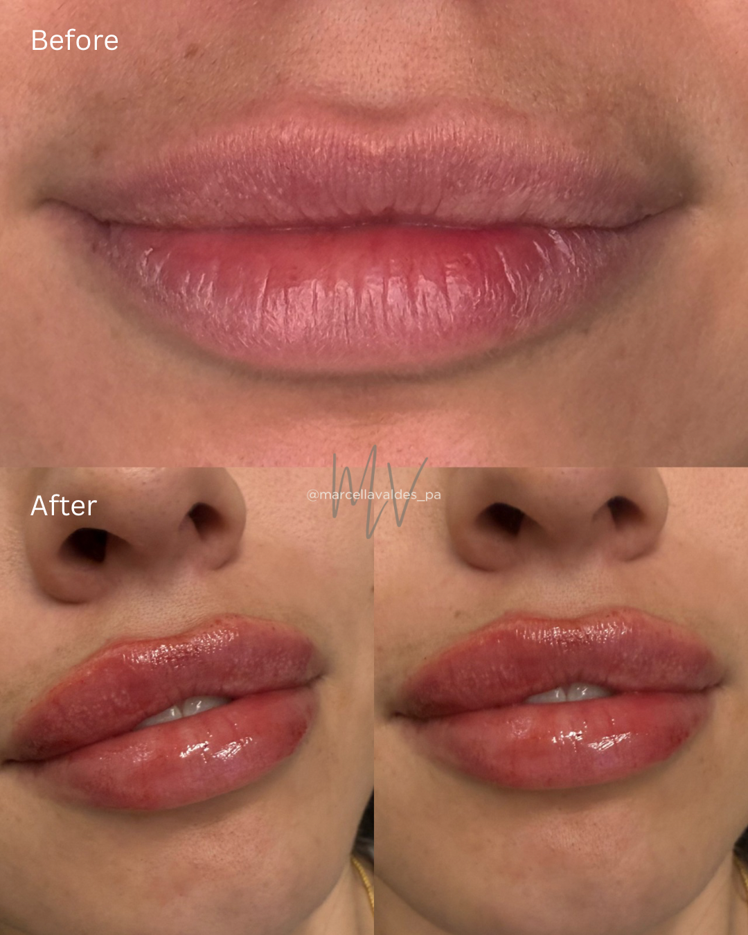 Lip filler before and after — EMVEE Medspa Coral Gables