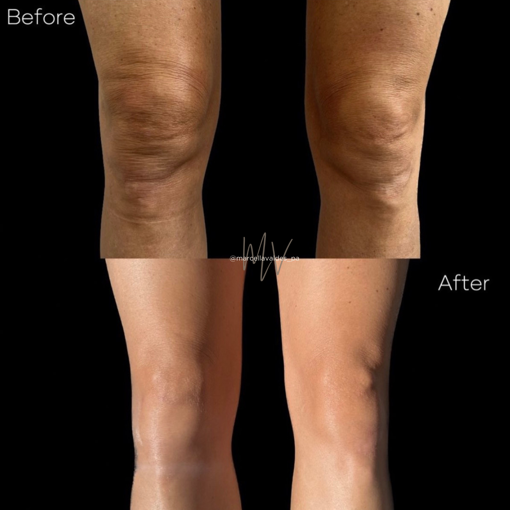 Morpheus8 knees before and after — EMVEE Medspa Coral Gables