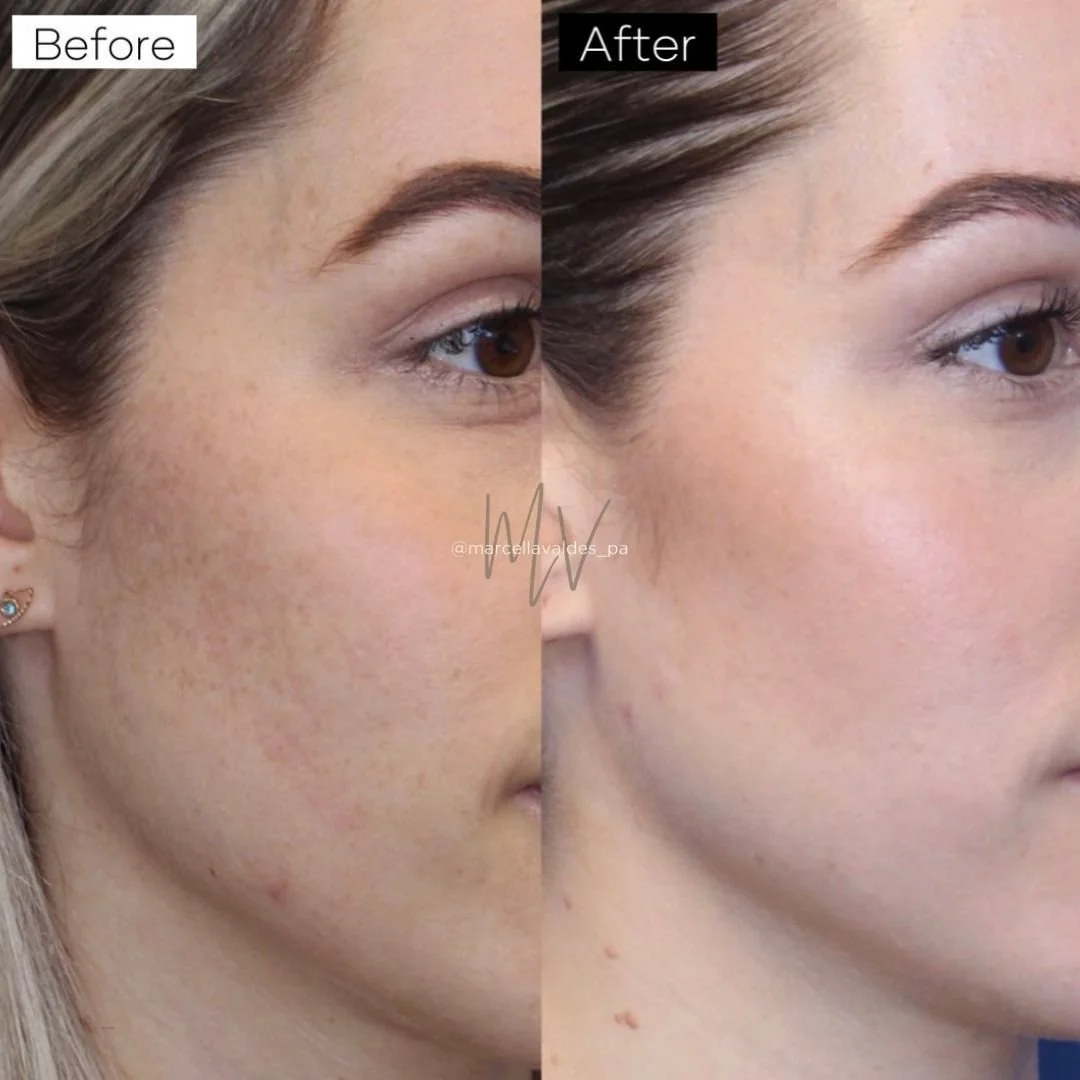 Skin and texture PRF before and after — EMVEE Medspa Coral Gables