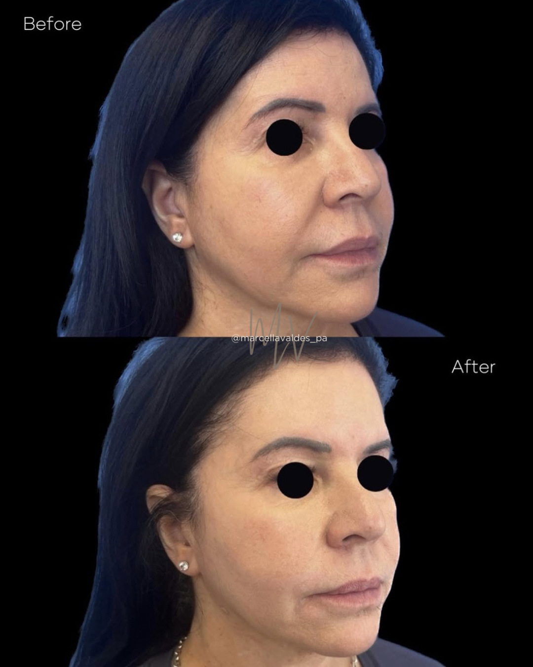 Morpheus8 face before and after — EMVEE Medspa Coral Gables