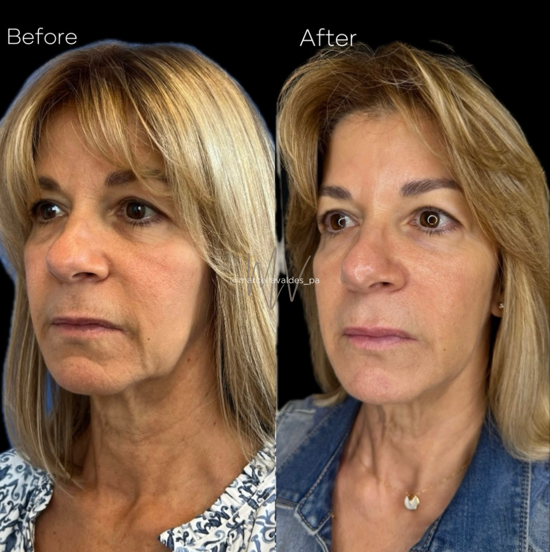 Sculptra and Morpheus8 combo before and after — EMVEE Medspa Coral Gables