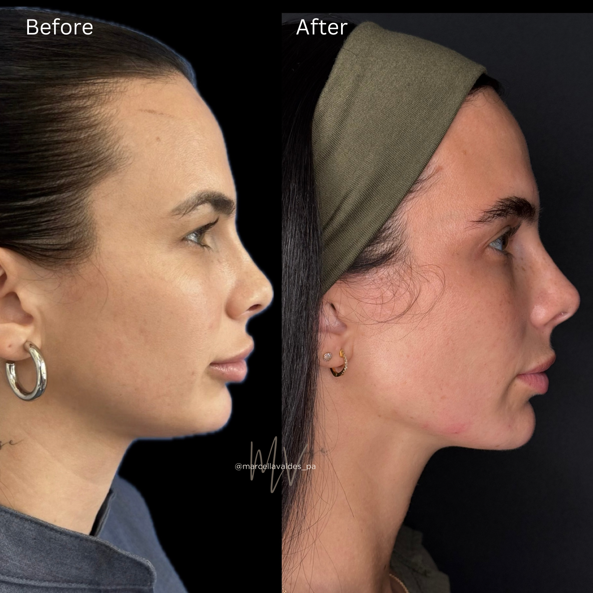 Jawline filler with lip rehab before and after — EMVEE Medspa Coral Gables