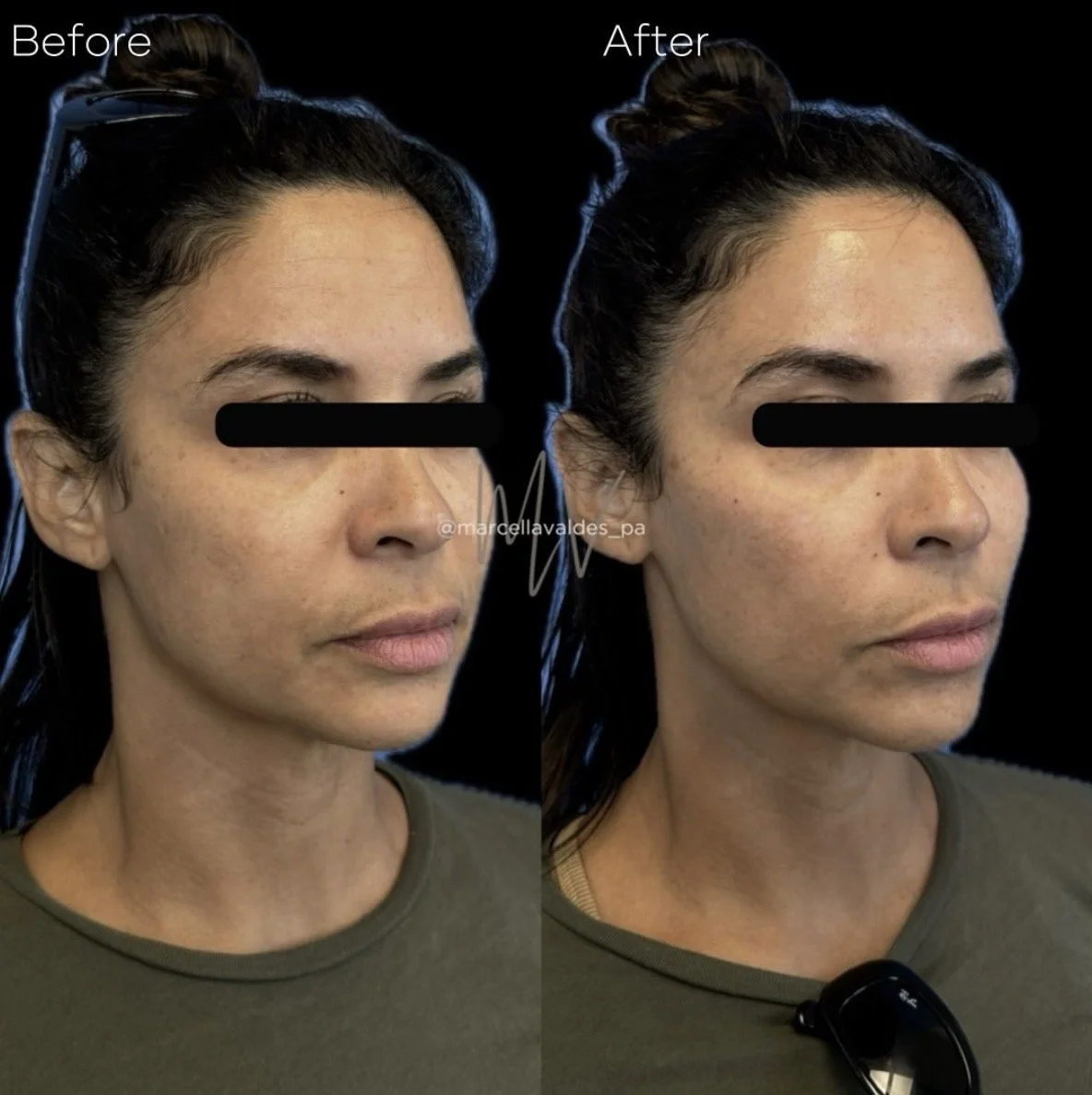 Cheek and midface filler before and after — EMVEE Medspa Coral Gables
