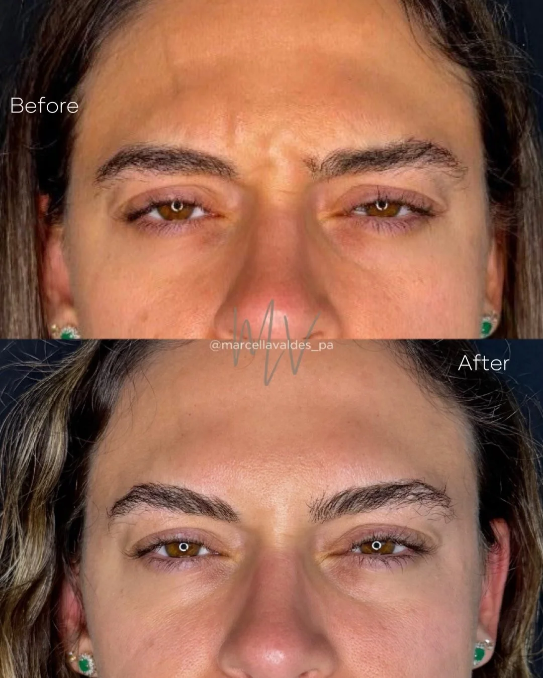 Glabella Botox before and after — EMVEE Medspa Coral Gables