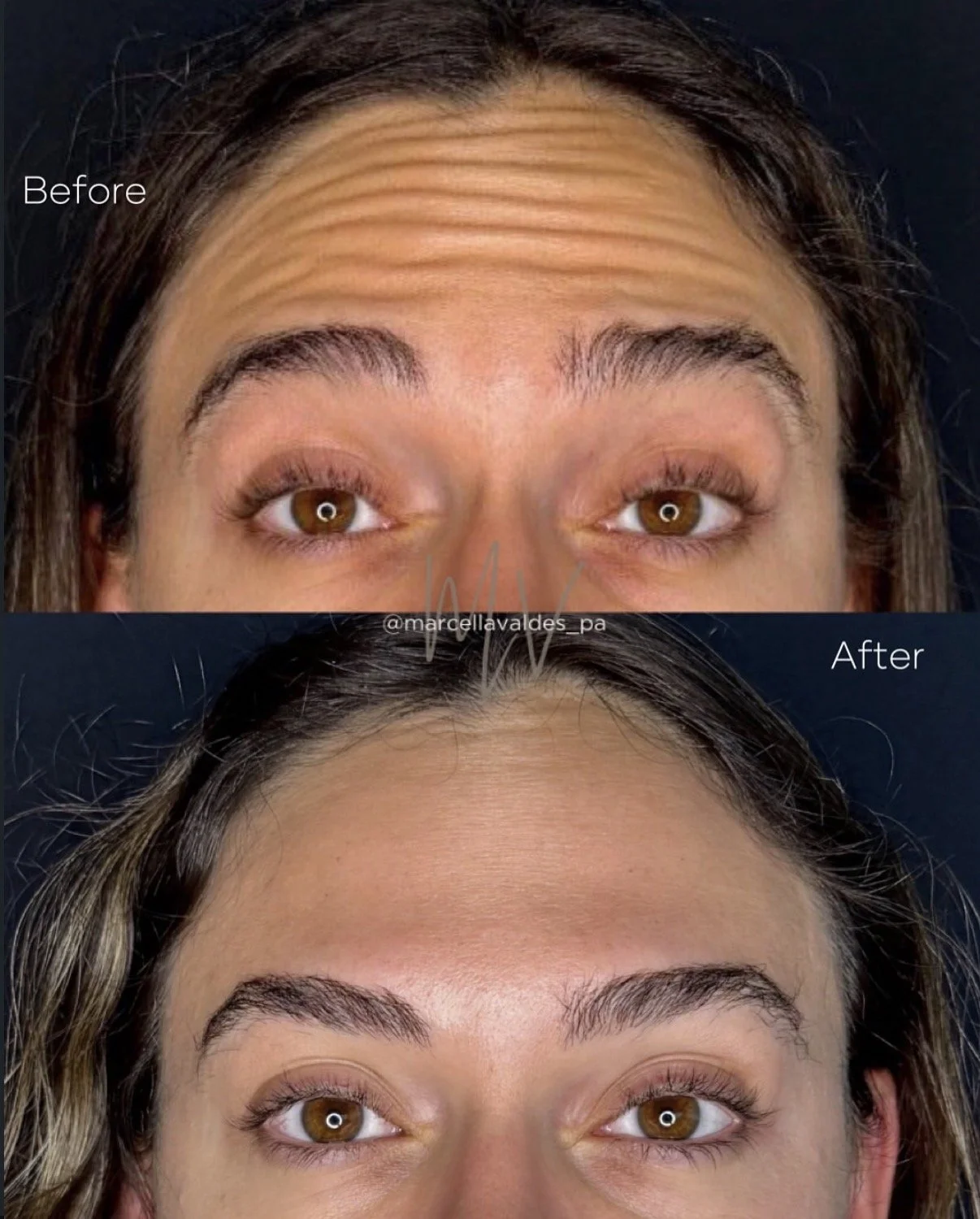 Forehead Botox before and after — EMVEE Medspa Coral Gables
